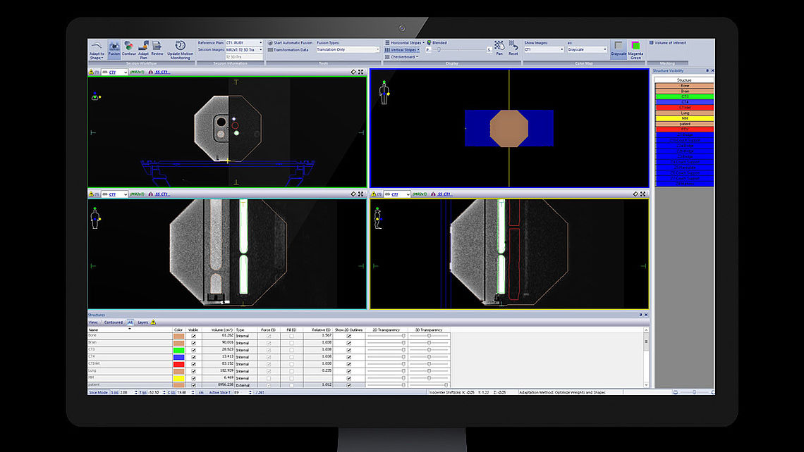 System QA RUBY phantom set up on Elekta Unity: Image registration during patient workflow in Monaco treatment planning system